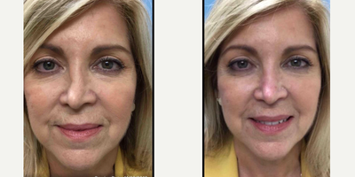 Nonsurgical Nose Job before and after photo