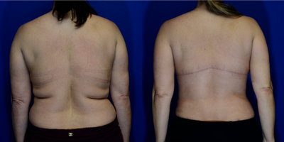 Back Lift before and after photo
