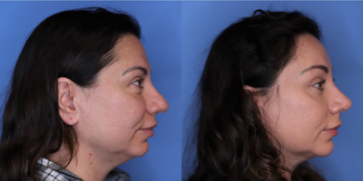 Chin Implant before and after photo