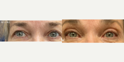 Eyelid Surgery before and after photo