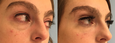 Belotero before and after photo