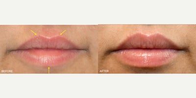 Dermal Fillers before and after photo