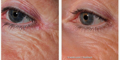Laser Genesis before and after photo