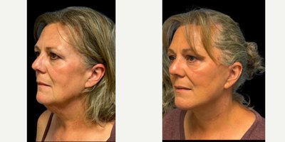 Mohs Surgery before and after photo