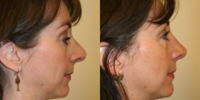 Revision Rhinoplasty before and after photo
