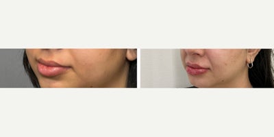 Lip Fillers before and after photo