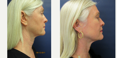 ThermiTight before and after photo