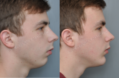 Chin Implant before and after photo