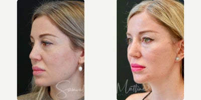Deep Plane Facelift before and after photo