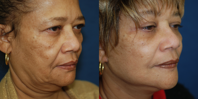 Facelift before and after photo