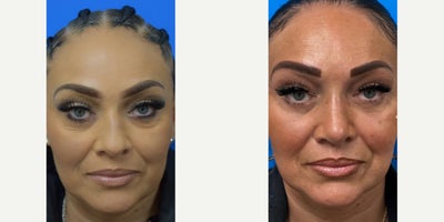 Rhinoplasty before and after photo