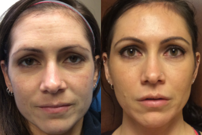 Bellafill before and after photo