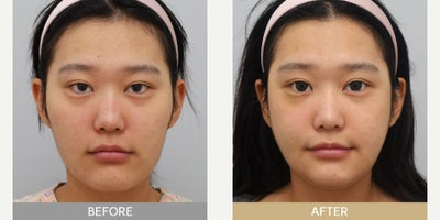 Jaw Reduction before and after photo