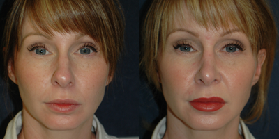 Rhinoplasty before and after photo