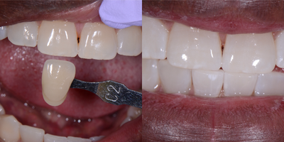 Zoom Whitening before and after photo