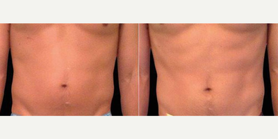 Emsculpt before and after photo