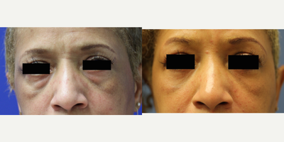 Eyelid Surgery before and after photo