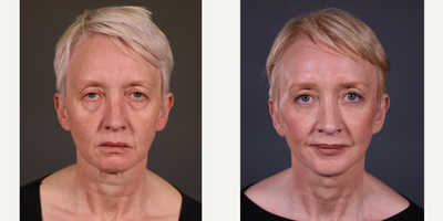 Facelift before and after photo