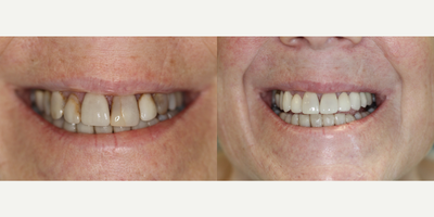 Porcelain Veneers before and after photo