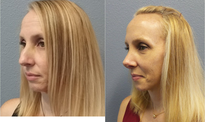 Rhinoplasty before and after photo