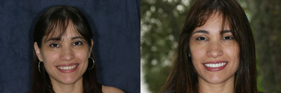 Smile Makeover before and after photo