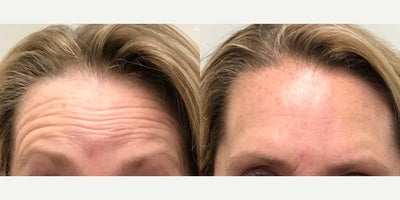 Dysport before and after photo