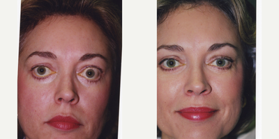 Eyelid Retraction Repair before and after photo