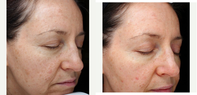 IPL before and after photo