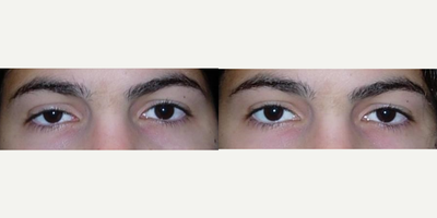 Ptosis Surgery before and after photo