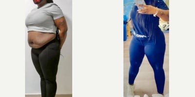 Tummy Tuck before and after photo