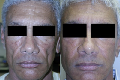 Silicone Injections before and after photo