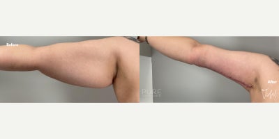 Arm Lift before and after photo