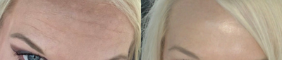 Botox before and after photo