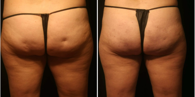 Cellfina before and after photo
