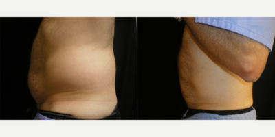 CoolSculpting before and after photo