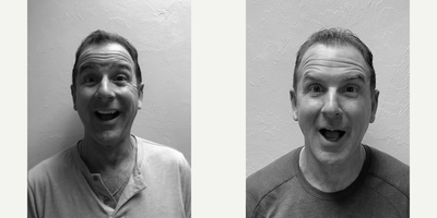 Dysport before and after photo