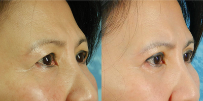 Eyelid Surgery before and after photo