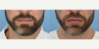 Lip Fillers before and after photo