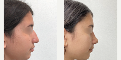 Rhinoplasty before and after photo