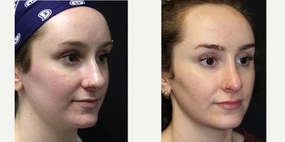 Rhinoplasty before and after photo