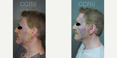 SMAS Facelift before and after photo