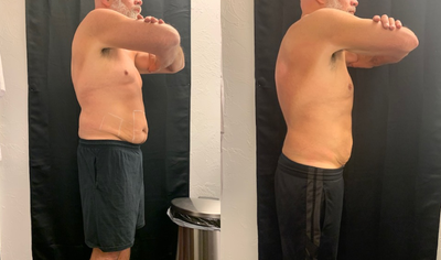truSculpt before and after photo
