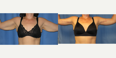 Arm Lift before and after photo