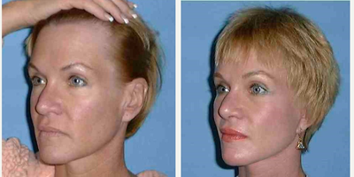 Cheek Lift before and after photo
