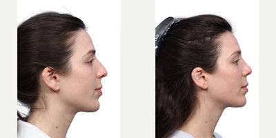Rhinoplasty before and after photo