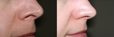 YAG Laser before and after photo