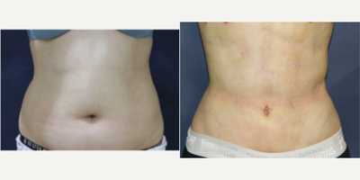 Abdominal Etching before and after photo