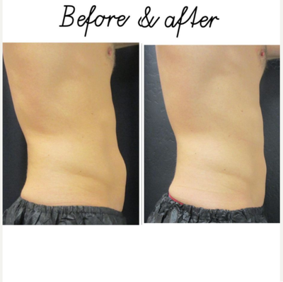 CoolSculpting before and after photo