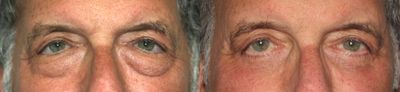 Eyelid Surgery before and after photo