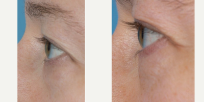 Eyelid Surgery before and after photo